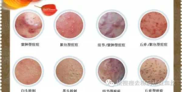 白头粉刺怎么办（女性阴部长白头粉刺怎么办）