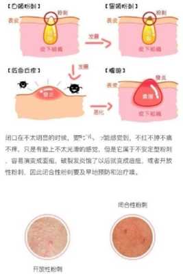 怎么去掉粉刺（去除粉刺闭口的方法）