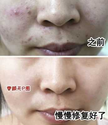 怎么清理粉刺（脸上有很多粉刺怎么去除）