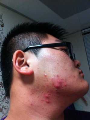 为什么脸上起痘痘（为什么脸上起痘痘痒）