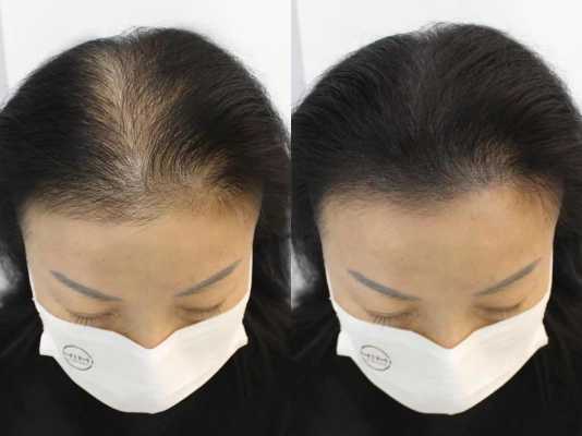 女性掉头发怎么办（女性掉头发严重治疗方法有哪些）