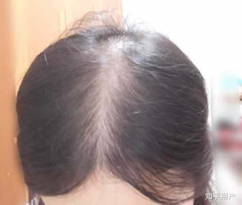 女生头秃怎么办,秃头怎么办女生图片