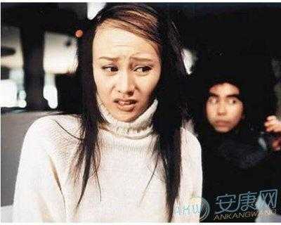 女生头秃怎么办,秃头怎么办女生图片
