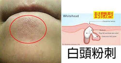 脸上的白头怎么去,怎么去白头粉刺最快最有效