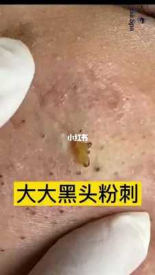 怎么治黑头（怎么治黑头最有效的方法）