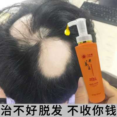治疗脱发最有效快速的方法,头发脱用什么洗发水好