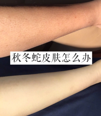 皮肤干起皮怎么办（冬季皮肤干起皮怎么办）