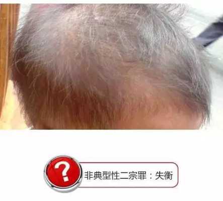 头发发黄是怎么回事,孩子头发发黄是怎么回事