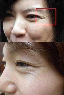 眼角纹怎么办（眼角纹怎么办啊）