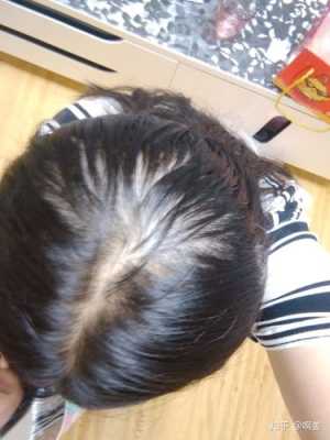 为什么后脑勺头发会越来越少,头发怎么越来越少啊怎么解决
