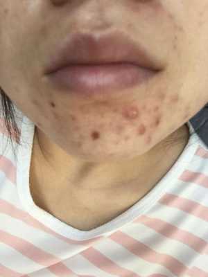 下巴起痘痘怎么办（下巴起痘痘怎么办才能消除）