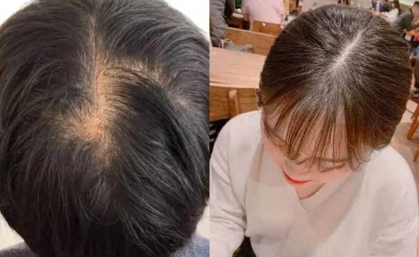 头皮是什么颜色（头皮是什么颜色为正常）