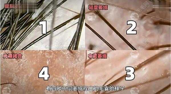 毛囊坏死怎么办（毛囊坏死可以恢复吗）