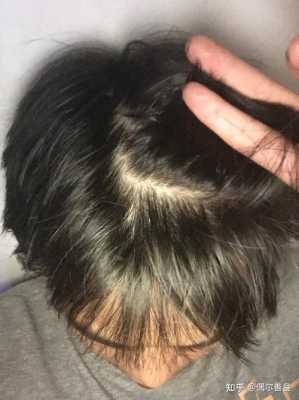 怎么让头发密（怎么让头发密度增加）