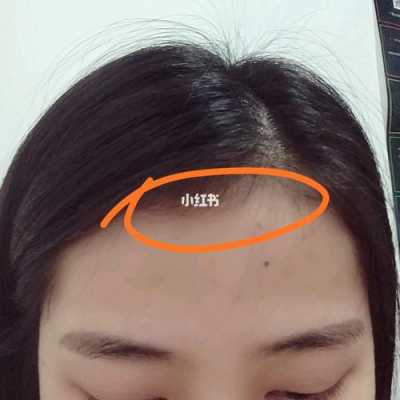 头发碎怎么办（头发有碎毛咋办）