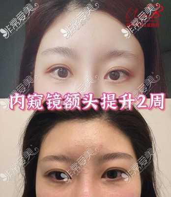 额头高怎么（额头高怎么改善）