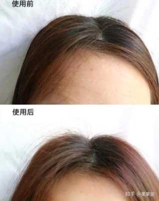 头发出油厉害什么原因（头发油光发亮是什么原因）