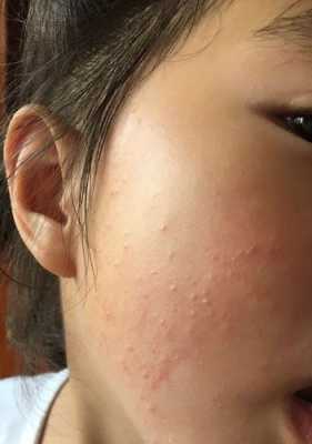 毛孔堵塞长小颗粒怎么办,毛孔堵住了怎么办?
