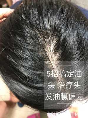 油性头发是什么原因（油性头发是什么原因造成的）