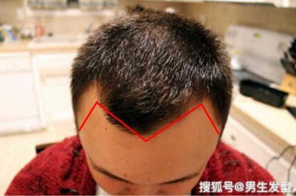 m发际线怎么办（m发际线怎么补救学生党）