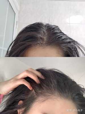 什么叫油性头发,干性头发变成油性头发怎么回事