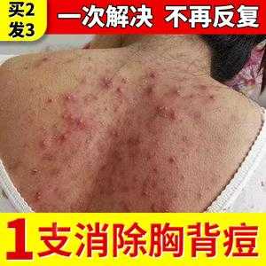 背上有痘痘怎么去除,怎么消除背上的痘痘和痘印
