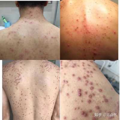 背上有痘痘怎么去除,怎么消除背上的痘痘和痘印