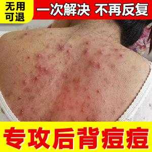 背上有痘痘怎么去除,怎么消除背上的痘痘和痘印