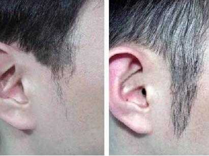头发秃鬓角怎么办（头发秃鬓角怎么回事）