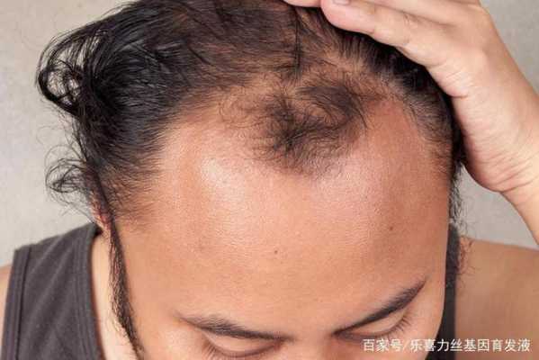 怎么判断脂溢性脱发（怎样判断自己是不是脂溢性脱发）