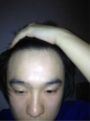 发际线为什么会变高（为啥明明头发很多为什么发际线还那么高）