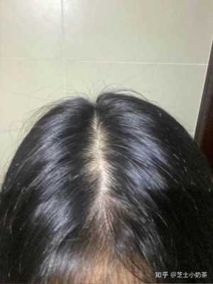 头发掉的很多怎么办（掉头发厉害长出来很多短发怎么办）
