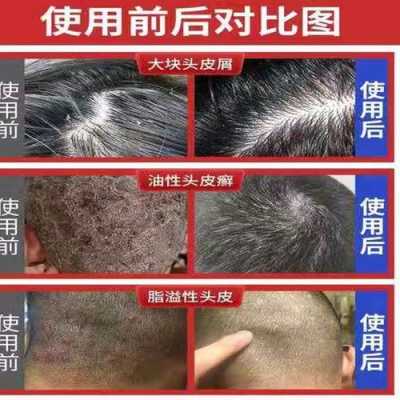 用什么方法去头皮屑（用什么方法去头皮屑最好最快）