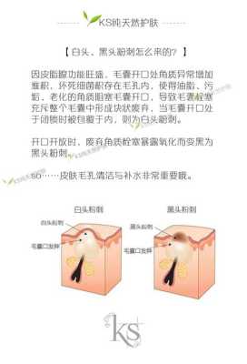 白头粉刺的治疗方法,白头粉刺怎么形成的