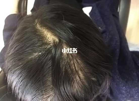 油脂性脱发怎么治疗（油脂性脱发怎么治疗最好）
