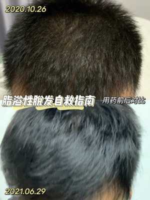 油脂性脱发怎么治疗（油脂性脱发怎么治疗最好）