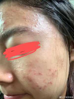 闭口粉刺是什么,闭口粉刺是什么样的图片