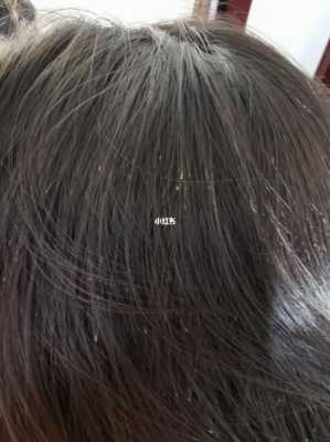 头发掉的很厉害怎么办（头发掉的厉害原因是什么）