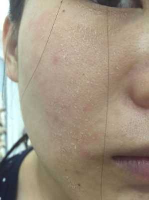 脸部皮肤起皮怎么办（冬天脸部皮肤起皮怎么办）
