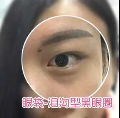 眼袋发黑是怎么回事,黑眼圈眼袋是什么原因造成的