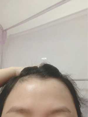 发际线上移怎么办（发际线上移怎么办啊）