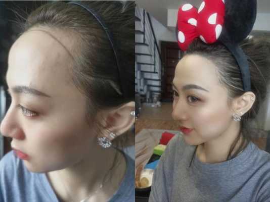 发际线上移怎么办（发际线上移怎么办啊）
