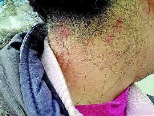 染头发过敏了怎么办（染发过敏应该怎么办）