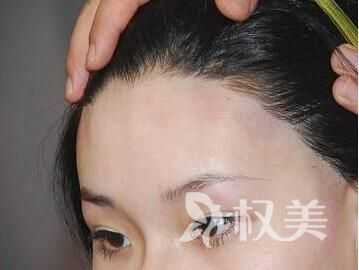 额头头发越来越少了怎么办,额头头发稀少怎么办女生
