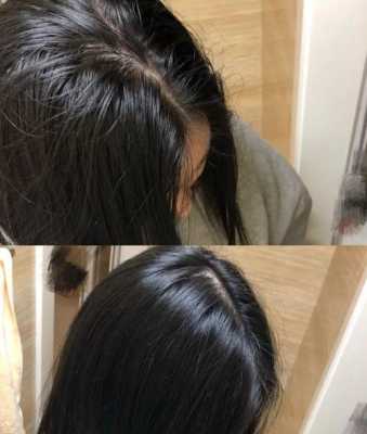 头发容易脱落怎么办,头发容易脱落怎么办女生
