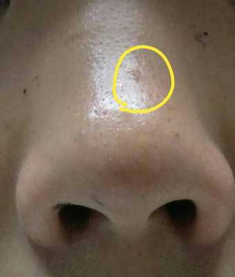 鼻子上长粉刺怎么办（鼻子有粉刺怎么办）