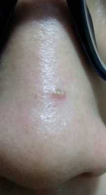 鼻子上长粉刺怎么办（鼻子有粉刺怎么办）