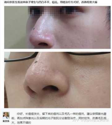 鼻子上有痘印怎么办（鼻子上有痘印怎么办才能消除）