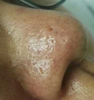 鼻子上有痘印怎么办（鼻子上有痘印怎么办才能消除）
