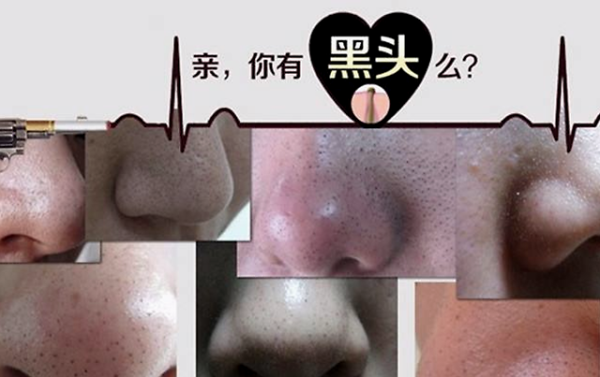 有黑头毛孔粗大怎么办（怎么解决黑头毛孔粗大）